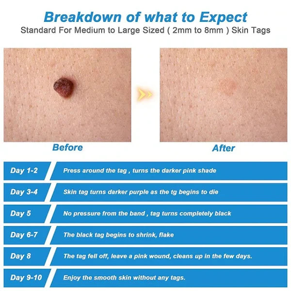 Auto Skin Tag Remover Painless | Skin Tag Removal Kit Adult Mole Wart Remover