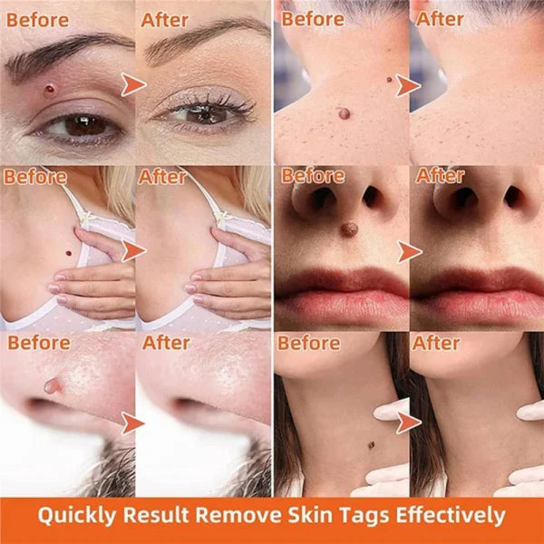 Auto Skin Tag Remover Painless | Skin Tag Removal Kit Adult Mole Wart Remover
